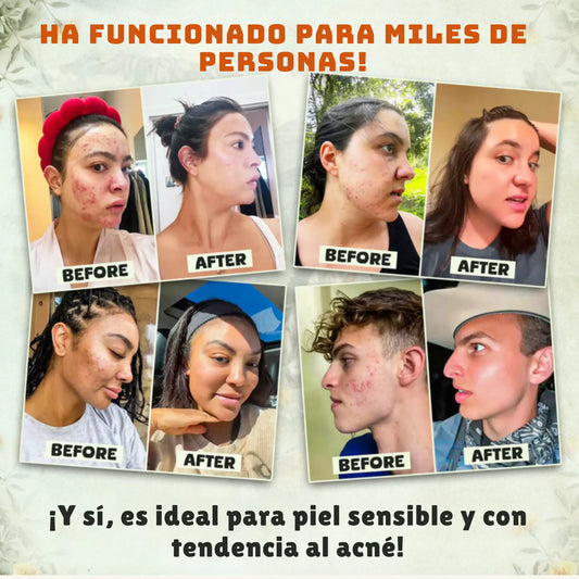 Resultados antes y después del bálsamo con sebo de vaca y miel de Manuka en piel con acné y sensibilidad
