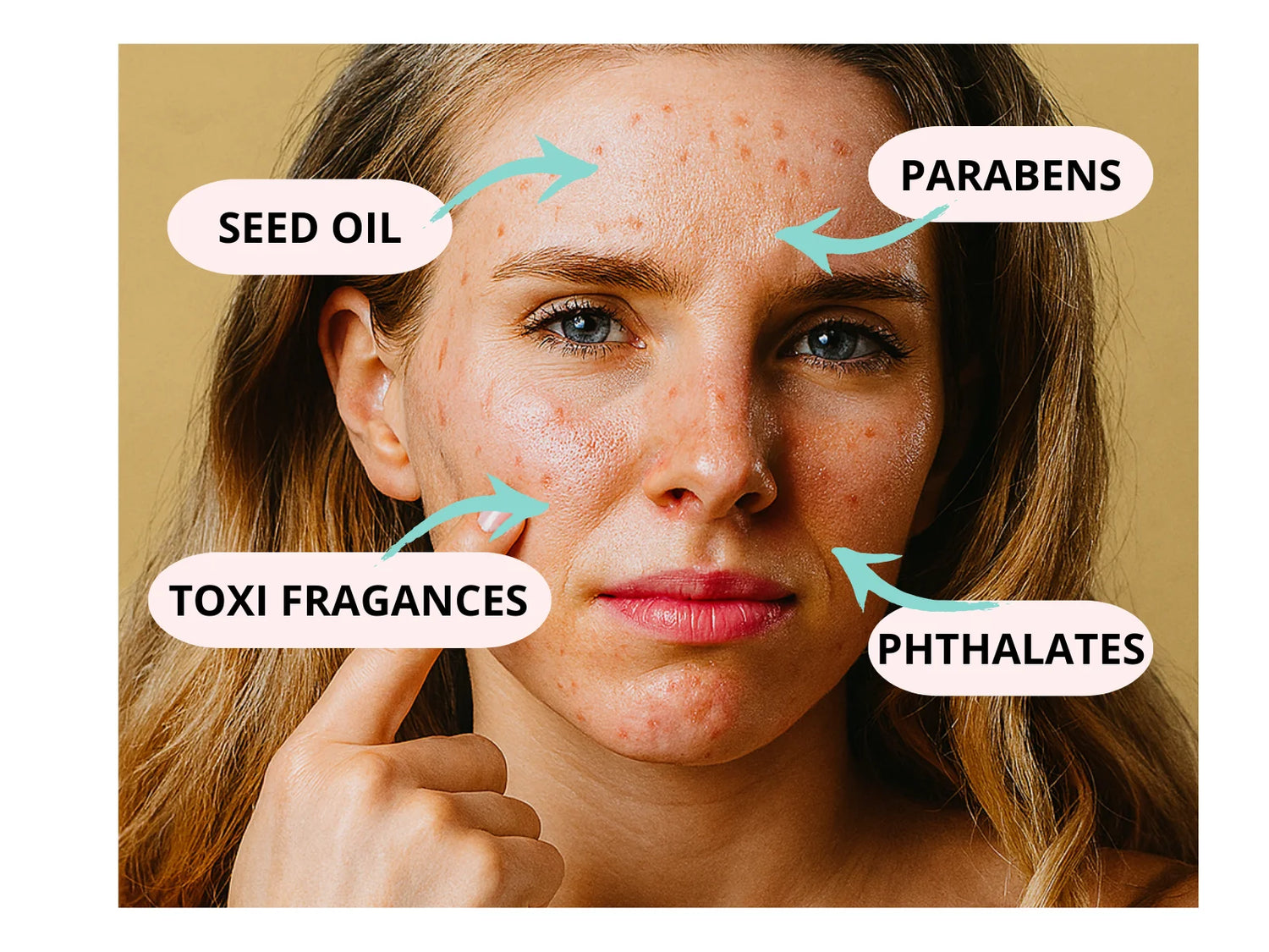 Mujer con acné en el rostro señalando una mejilla, representando irritación causada por productos con fragancias, aceites minerales y químicos tóxicos.
